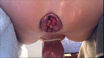 hd крупным планом от моего экстремального анального зияния и пролапса porn